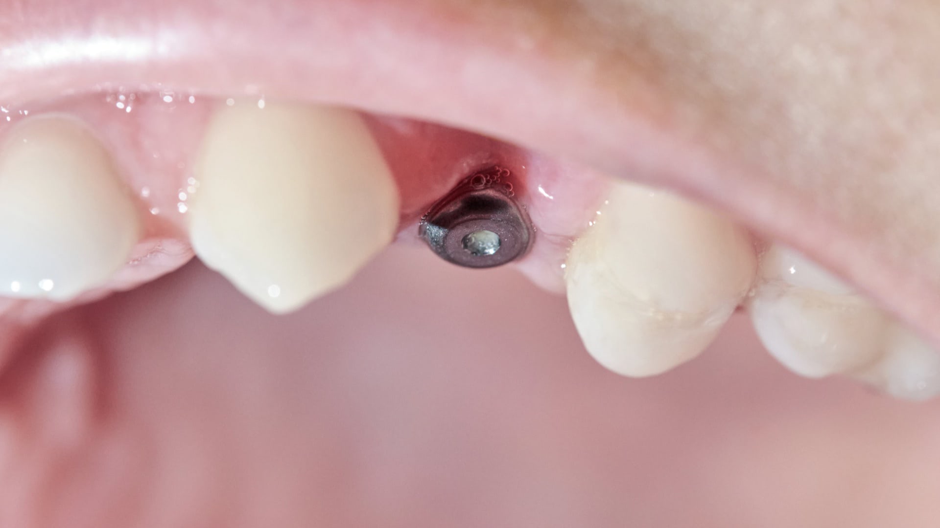 Periodontoloji Görsel