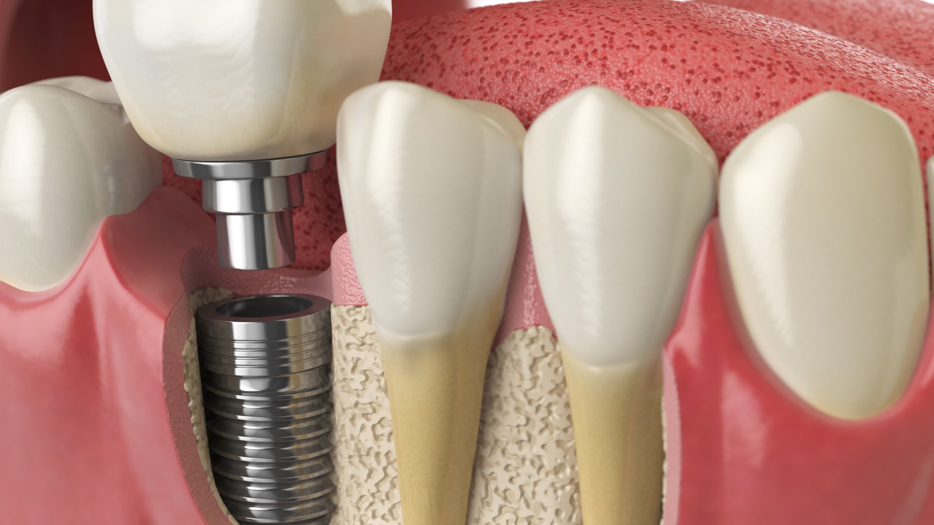 Implantology Image