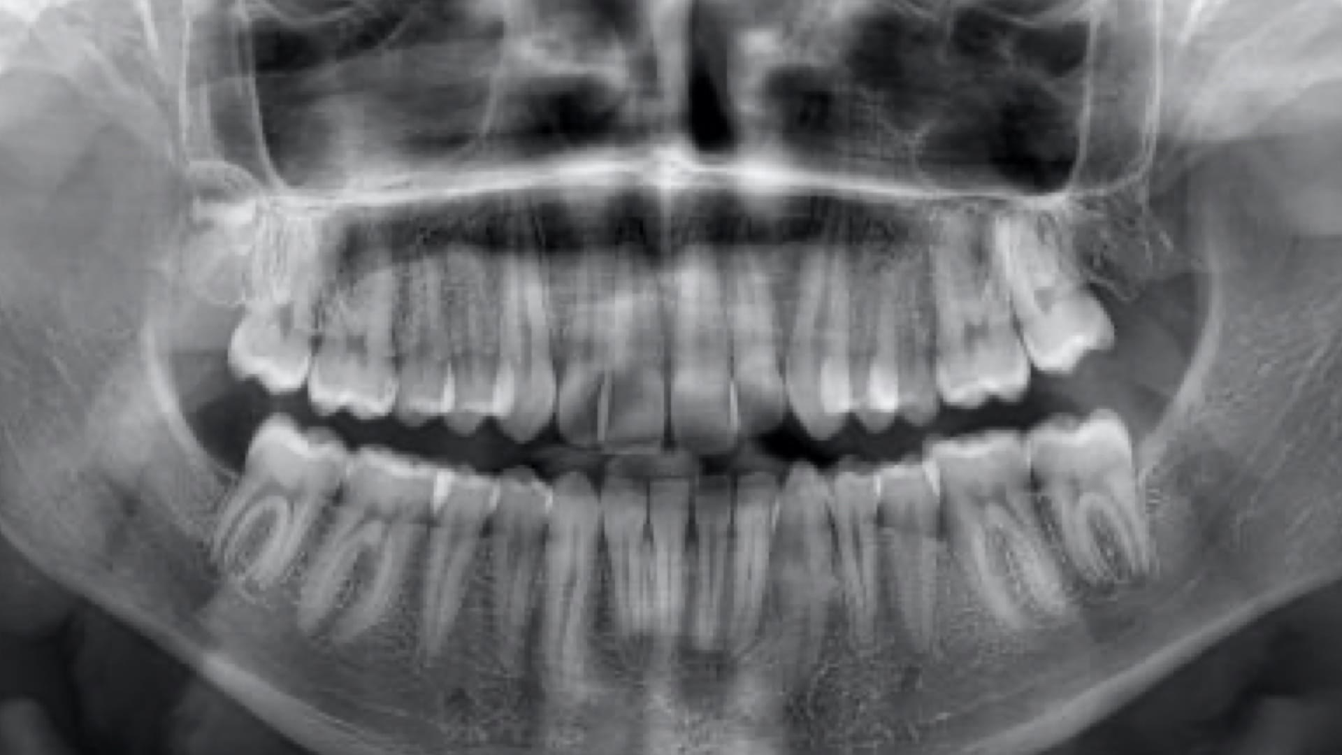 Dental Radiology Image