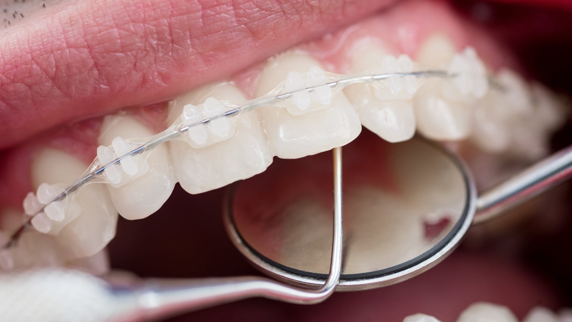 Post-Orthodontic Retainers: Duration and Usage - Image